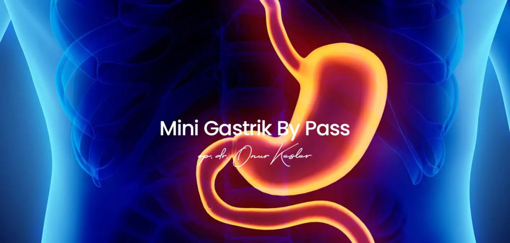 Mini Gastrik By Pass