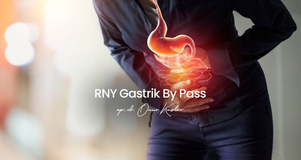 RNY Gastrik By Pass